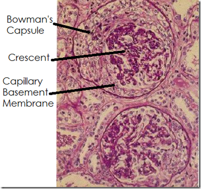 Pathology of Common Glomerular Diseases - Medatrio